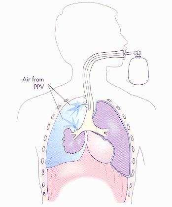 proceder à administração de ventilações com AMBÚ e oxigênio a 15 litros por minuto; 12º- Observar sinais de pneumotórax hipertensivo (pode ser ocasionado pela ventilação por pressão positiva); 13º-