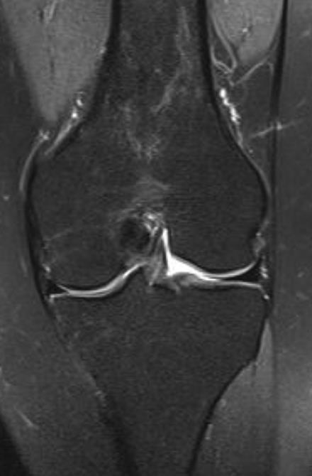 PLATÔ TIBIAL E FÊMUR