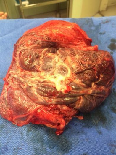 Histerectomia com placenta in situ Conduta