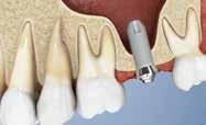 Dispor de osso suficiente é essencial para garantir a estabilidade duradoura dos implantes dentários.