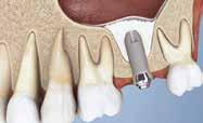 Escaneie o código e veja o vídeo: GANHO DE ALTURA ÓSSEA Na região de molares superiores, um procedimento chamado de elevação do
