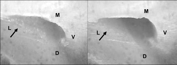 61 FIGURA 1 - A imagem pré-operatória (esquerda) e imagem pós-operatória (direita) mostrando a ausência de instrumentação na a parede lingual (seta). M, mesial; D, distal, V, vestibular; L, lingual.
