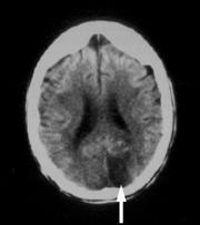 TRAUMA CRANIO-ENCEFÁLICO: VENTILAÇÃO MECÂNICA: DRIVE MANTIDO: PSV 5-25 VC=400-500ml FR <28 PaCO2 = 30-39 mmhg * ETCO2 PEEP= 5-10 cmh20 FIO2 para PaO2 entre 80-120