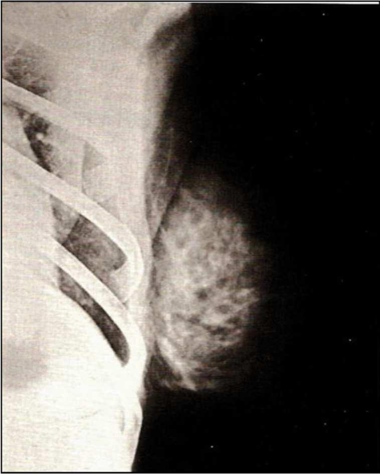 36 Figura 9 - Radiografia da mama adquirida em meados de 1927. Fonte: INCA, 2012.