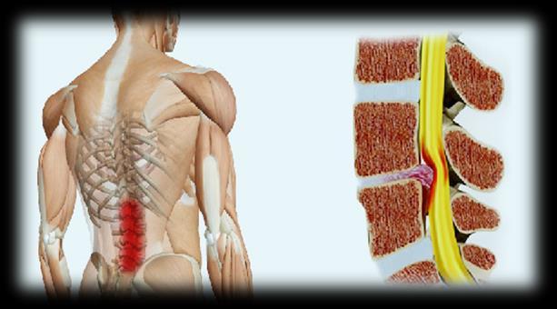 Com o aumento da longevidade da população, é esperada também maior frequência de pacientes com doenças degenerativas da coluna vertebral, necessitando uma abordagem clínica adequada 1.