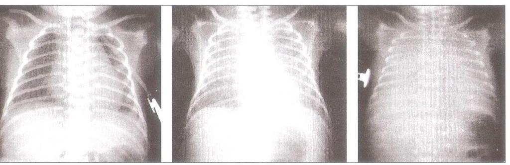 39 (aumento da confluência das densidades pulmonares levando à opacificação completa do pulmão) (MIYOSHI; KOPELMAN, 2004; ADAS et al., 2005), de acordo com a figura 4.