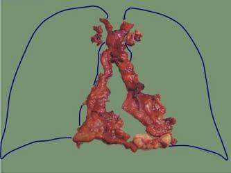 A figura 1 mostra o mediastino desnudo e as figuras 2 e 3 mostram respectivamente o que foi ressecado de um paciente miastênico sem timoma e com