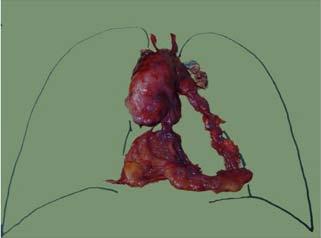 Figura 4. Gordura mediastínica e timo com um timoma no lobo direito ressecado de um paciente miastênico.