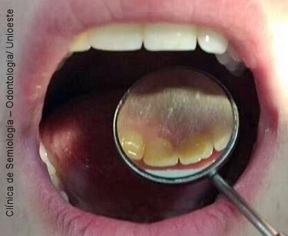 Dentes 37 e 47 apresentaram lesão de cárie.
