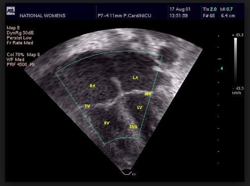 Cuidados Cardiovasculares Considerar ecocardiograma nas primeiras 24h após iniciar