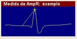 campo. Para medir a amplitude da onda R, clique com o botão esquerdo do mouse sobre o ponto isoelétrico da curva e, em seguida, clique sobre o pico da onda R, conforme figura abaixo.