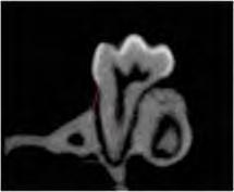 FIGURA 7 (A e B) Representação esquemática da mensuração linear na face palatina das raízes distal do primeiro