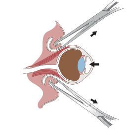 Figura 3- Procedimento de recolocação do globo ocular, após o prolapso. As margens palpebrais devem ser desenroladas e esticadas, ao mesmo tempo que o globo ocular é empurrado no sentido da órbita.