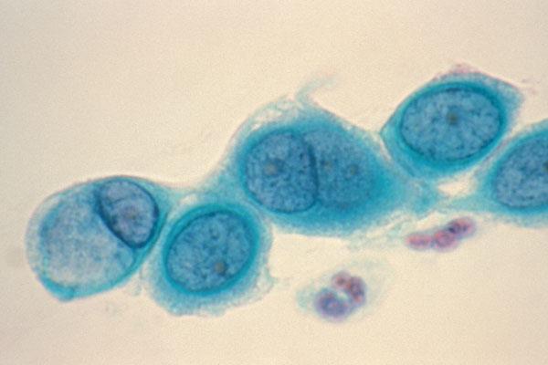 4. Linfogranuloma venéreo:. Causada pela bactéria Chlamydia trachomatis.