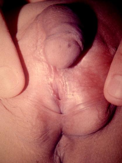 Tecido testicular e tecido ovariano em um mesmo indivíduo