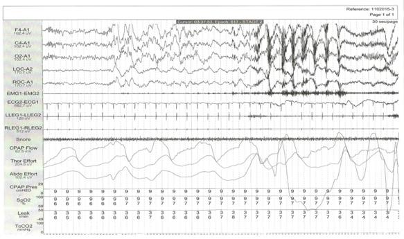 37 Em qual derivação identificamos melhor as ondas do vértex e os fusos do sono na polissonografia? F4-M1.