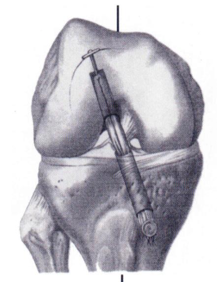 1. Informações de Identificação Nome Técnico: IMPLANTE PARA LIGAMENTO Nome Comercial: PLACA PARA LIGAMENTO MICRO BUTTON 1.1. Identificação do Produto A PLACA PARA LIGAMENTO MICRO BUTTON, fabricado