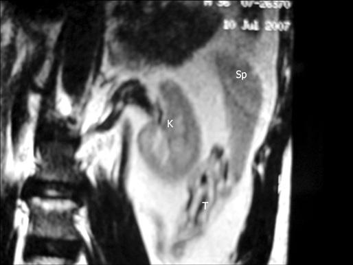 Fusão esplenogonadal e câncer testicular 93 RELATO DE CASO Paciente do gênero masculino, 36 anos, que apresentava infertilidade primária por 8 anos.