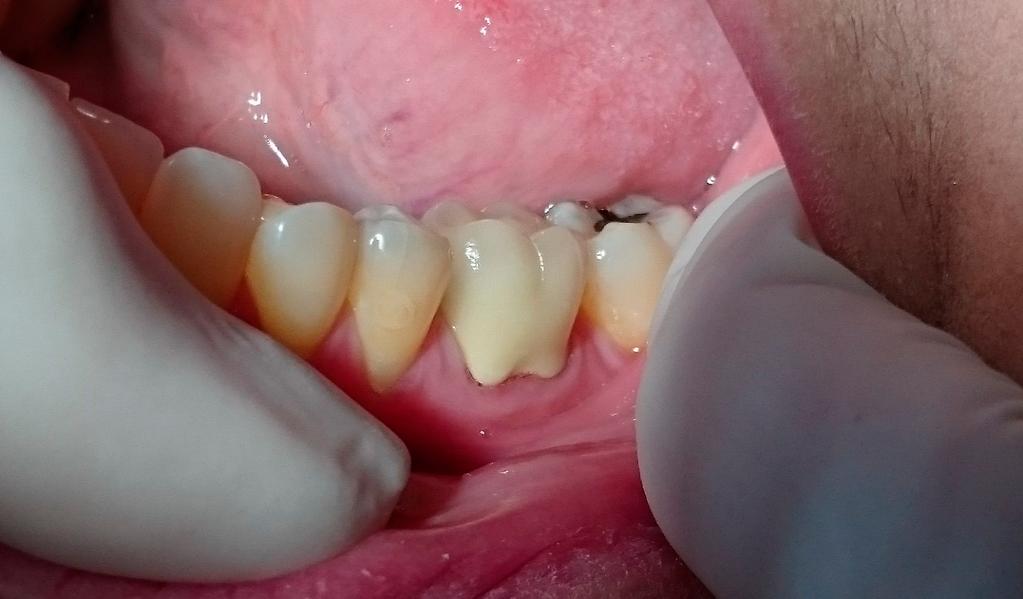 Figura 3. Ajuste do perfil emergencial Fonte: Curso de Especialização em Prótese Dentária SOBRESP (2015).