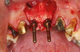 PLANO DE TRATAMENTO Confecção de implantes osseointegrados nos incisivos centrais superiores com a finalidade de promover uma reabilitação com elementos unitários proporcionando maior