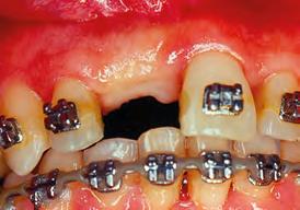 DIAGNÓSTICO Paciente gênero masculino, 21 anos, em final de tratamento ortodôntico, foi encaminhado pelo ortodontista com