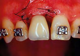 uma coroa clínica de tamanho cérvico incisal proporcional aos dentes adjacentes.