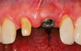 02,03 Aspecto da prótese fixa. Nota-se deficiência na estética com desvantagem de elementos unidos impossibilitando o fio dental.