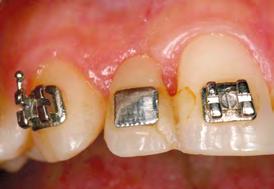 DIAGNÓSTICO Paciente gênero feminino, 18 anos, apresentava agenesia dentária do elemento 12, usando uma prótese adesiva em fase final do