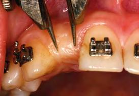 PLANO DE TRATAMENTO Substituição da prótese adesiva por implante osseointegrado, buscando a reabilitação funcional e estética do elemento