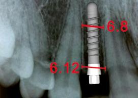 Observa 3,5mm de perfil de emergência e aproximadamente 1,5mm de papilas (mesial e distal).