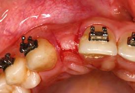 inserida e gerando uma coroa clínica de tamanho cérvico-incisal proporcional aos dentes adjacentes.