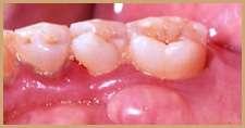 Doença periodontal Sobre qual doença periodontal