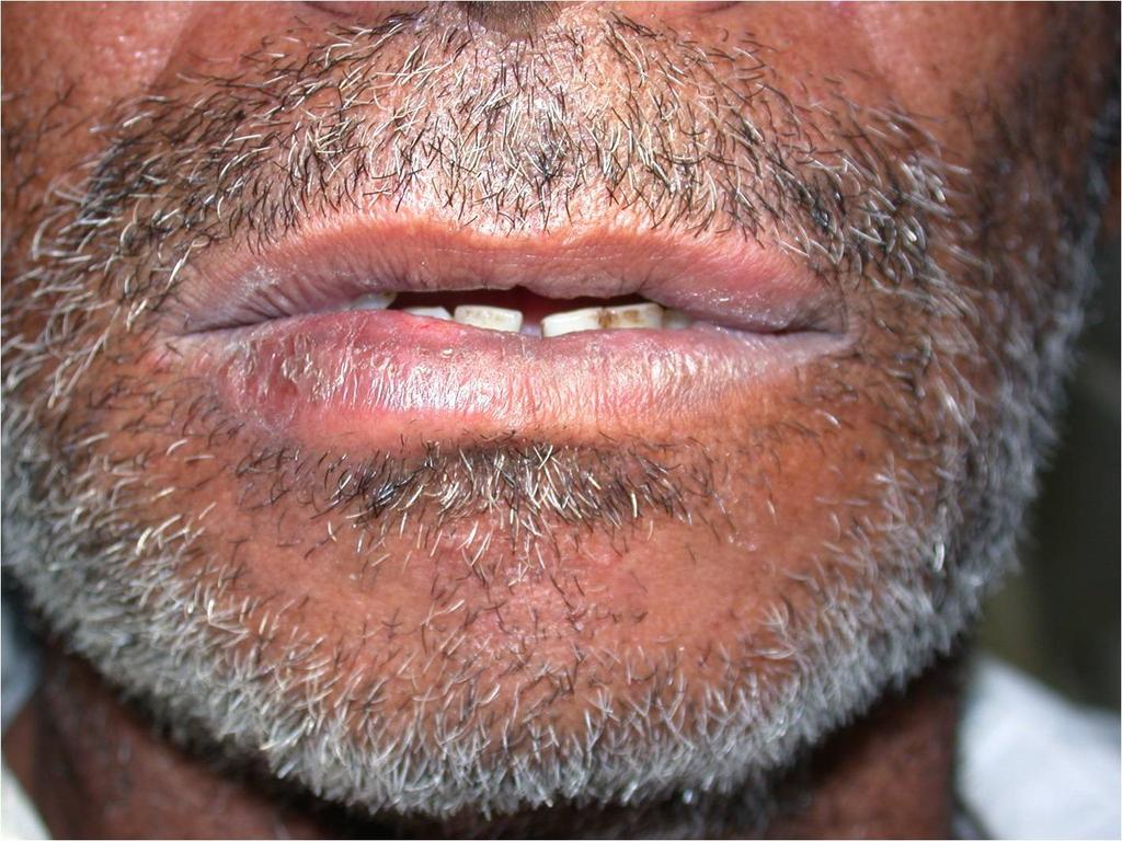 localizado no lado direito do lábio inferior do paciente (macroqueilia).