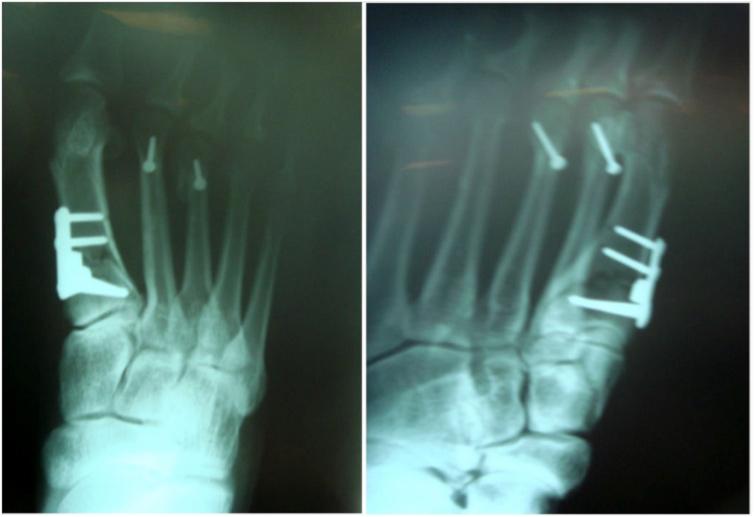 Bertolini FM, Marques RP, Pereira VA, Oliveira Júnior O Figura 5 - Radiografias em AP e oblíquo do pé de um dos pacientes, demonstrando o posicionamento da placa calço.