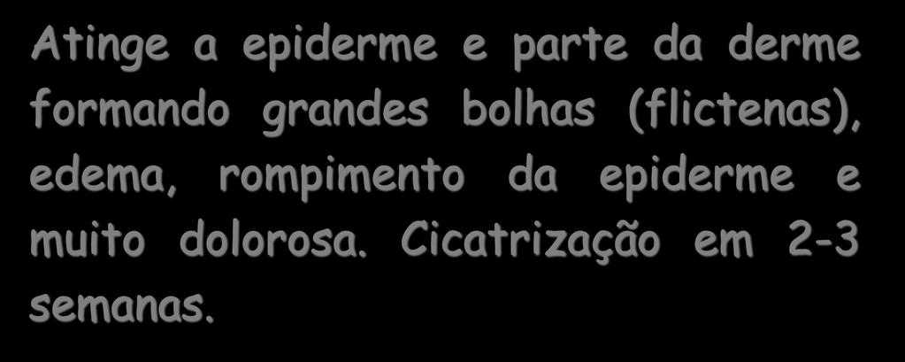 QUEIMADURAS 2º GRAU Atinge a epiderme e
