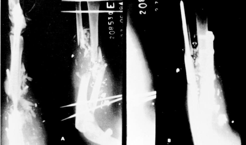 Foi tratada corn placa metálica no rádio e enxerto ósseo maciço da fíbula, evoluindo com resultado insatisfatório quanta às fraturas, mas razoável quanto à função da mão.