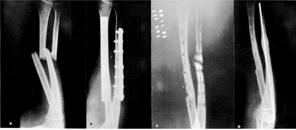 A.G. PARDINI JR. & M.P.C. OLIVEIRA Fig. 4 a-b-c-d) Fratura da diáfise dos ossos do antebraço tratada inadequadamente com material grosseiro e impróprio.