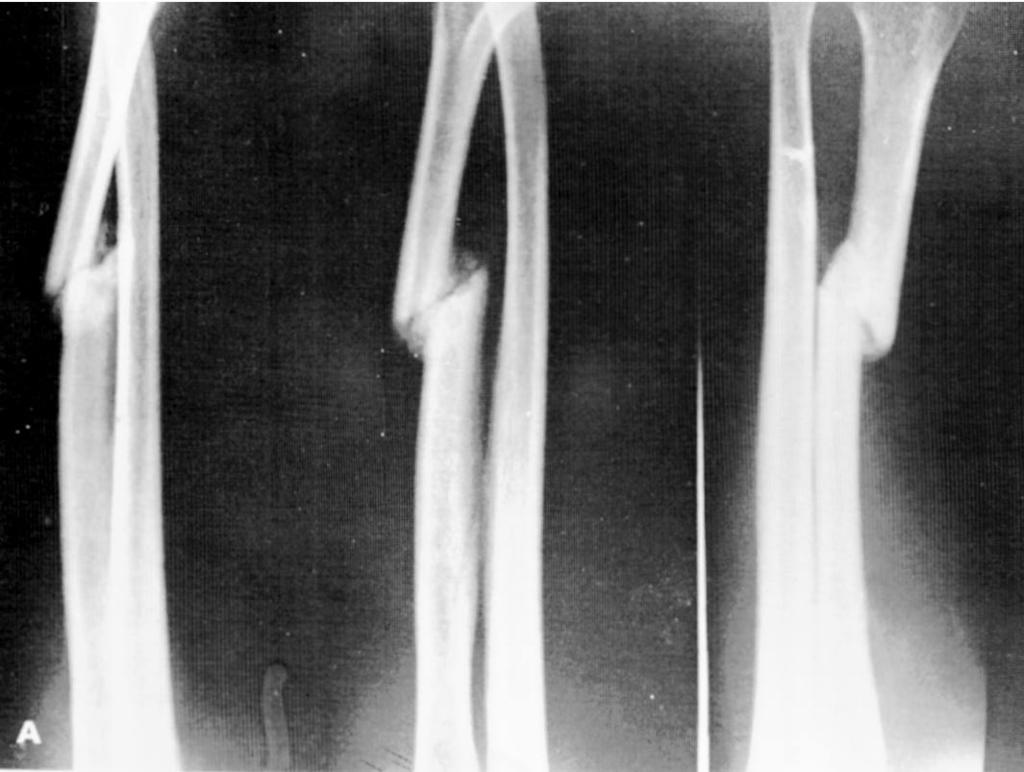 três anos. No caso de pseudoartrose do rádio. a lesão foi tratada com placa autocompressiva mais enxerto autógeno de crista ilíaca.