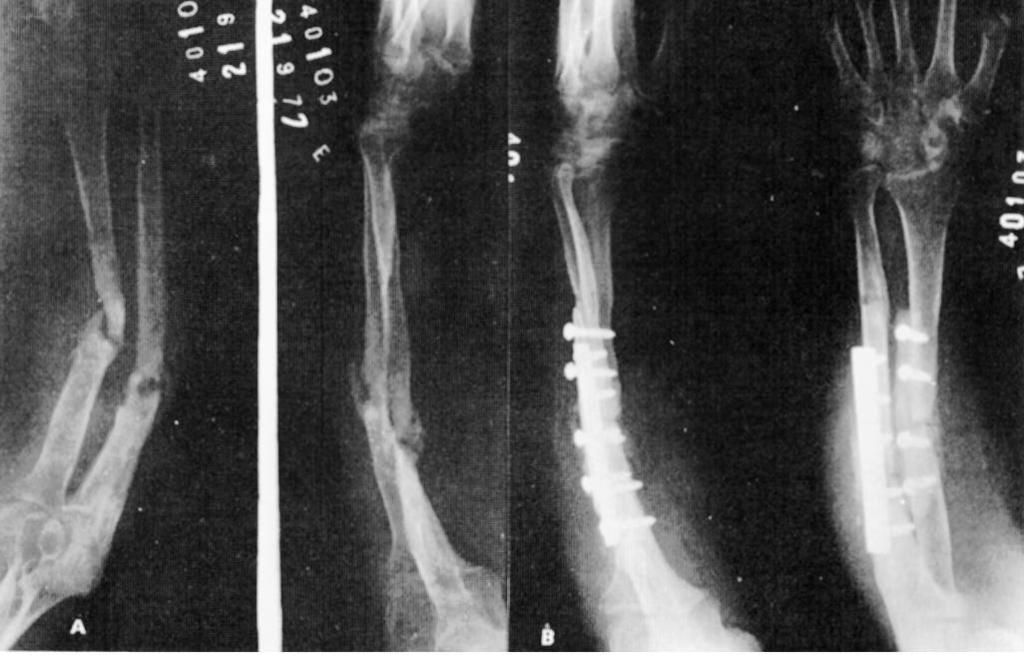 complicação de fratura isolada do rádio, sendo o tratamento a ressecção do calo ósseo que ligava um osso ao outro; d) Necrose de pele: no caso de necrose de pele, que ocorreu dentro do aparelho