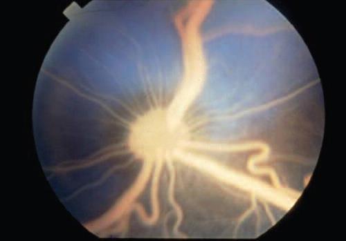 Na fundoscopia de animais com hiperlipedmia pode-se observar os vasos sanguíneos da retina com coloração branca ou rosa claro (Figura 14), caracterizando a lipemia retinalis.