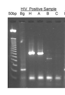 DIAGNÓSTICO CONFIRMATÓRIO Deteção do DNA do HIV-1 integrado ao genoma leucocitário - 2 ml de sangue coletados dos indivíduos com suspeita H, A, B e C; - Extração do DNA do sangue (leucócitos +