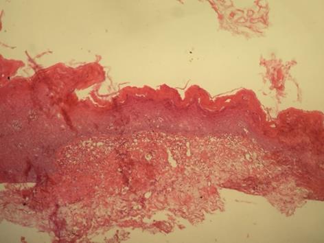 Figura 1: Aspecto Intrabucal Inicial visualiza-se placa esbranquiçada disseminada entre mucosa jugal e gengiva inserida, de aspcecto verrucoso e limites difusos.