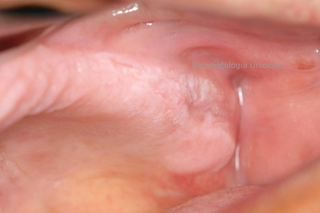Figura 2 (Clínica de Estomatologia da Unioeste Cascavel/PR): Leucoplasia, com limites indefinidos, superfície verrucosa, localizada em rebordo edêndulo superior direito.