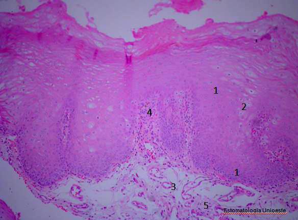 termo carcinoma in situ é usado e é definido como células epiteliais displásicas que se estendem da camada basal à superfície da mucosa bucal.