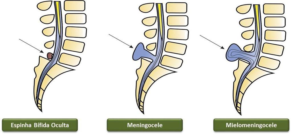 INTRODUÇÃO - 16 1.9 Defeito de Fechamento do Tubo Neural (DFTN) Há três tipos de malformações englobadas na espinha bífida: espinha bífida oculta, meningocele e mielomenigocele (Figura 1).