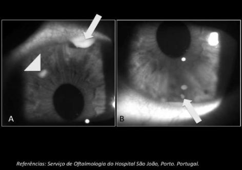 Fig. 10 - Sarcoidose ocular. A - Uveíte granulomatosa anterior com nódulo no estroma da íris (nódulo de Busacca) cabeça da seta - e nódulo superior no ângulo iridocorneano - seta.