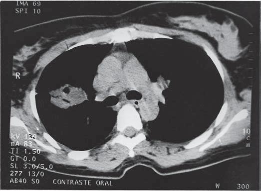 Criptococose pulmonar: aspectos na tomografia computadorizada MTERIIS E MÉTODOS Foi feito estudo retrospectivo das tomografias computadorizadas de tórax de 14 pacientes com criptococose pulmonar