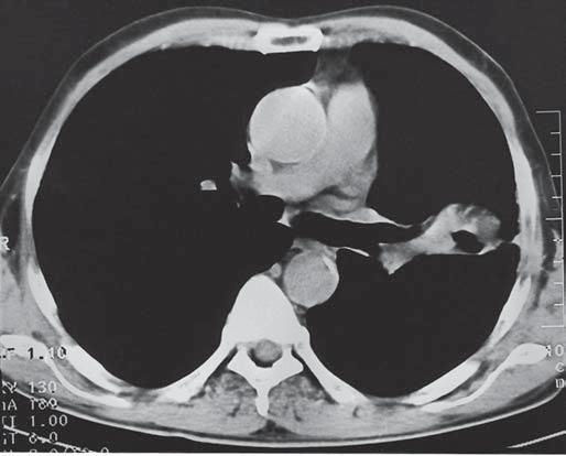 superior esquerdo. Em e C, tomografia computadorizada de tórax com janela para mediastino evidenciando a massa pulmonar com área de escavação (C).