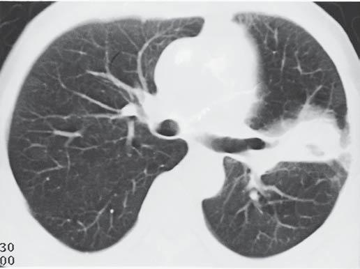 Um dos pacientes desenvolveu nódulos múltiplos, esparsos pelos pulmões, outro paciente apresentou nódulo associado à presença de infiltrado intersticial reticular (Figura 5), e em um outro caso houve