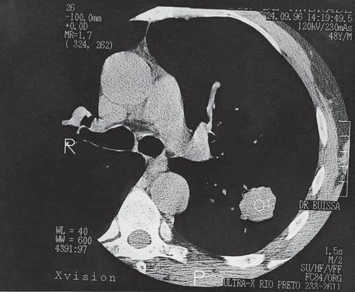 Criptococose pulmonar: aspectos na tomografia computadorizada Figura 3.
